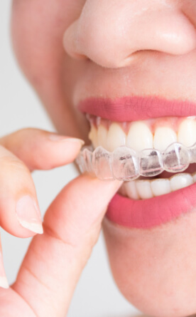 Invisalign